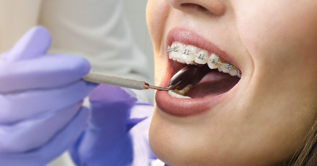 Discover The Best Dental Implants For A Perfect Smile