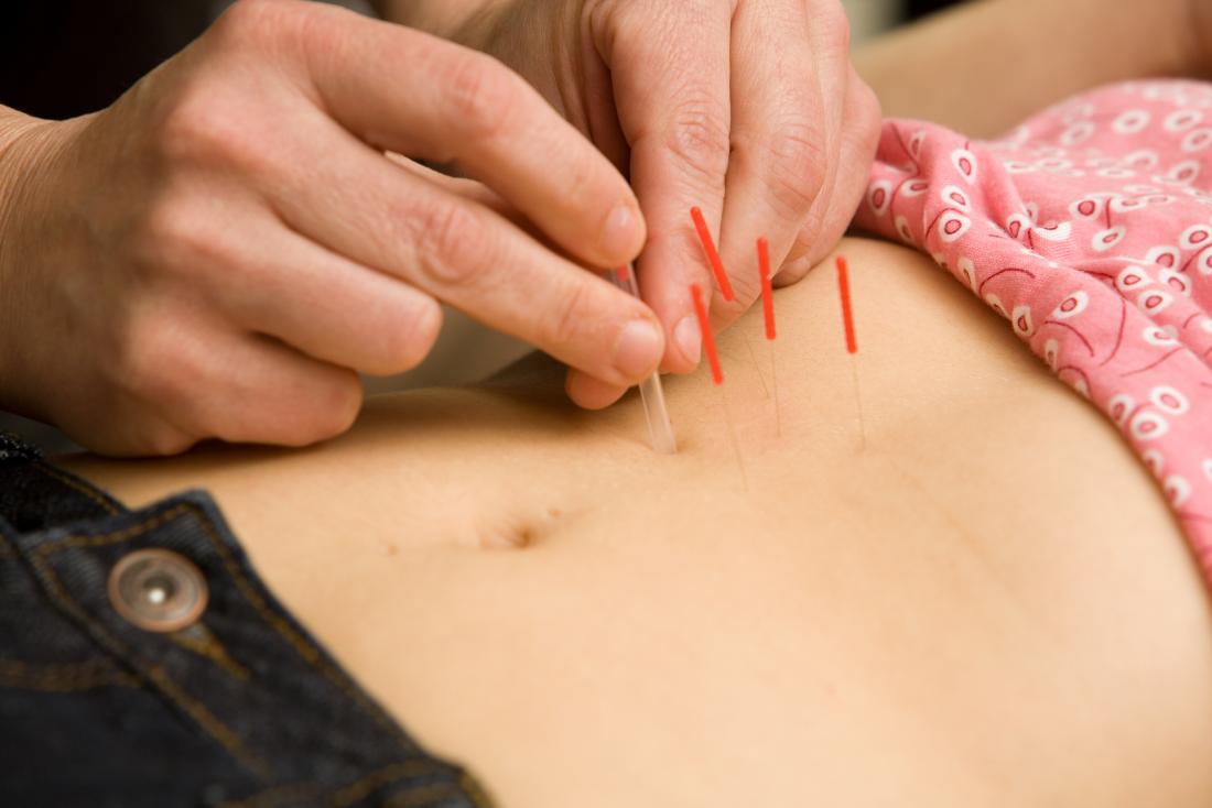How To Perform Acupuncture Therapy